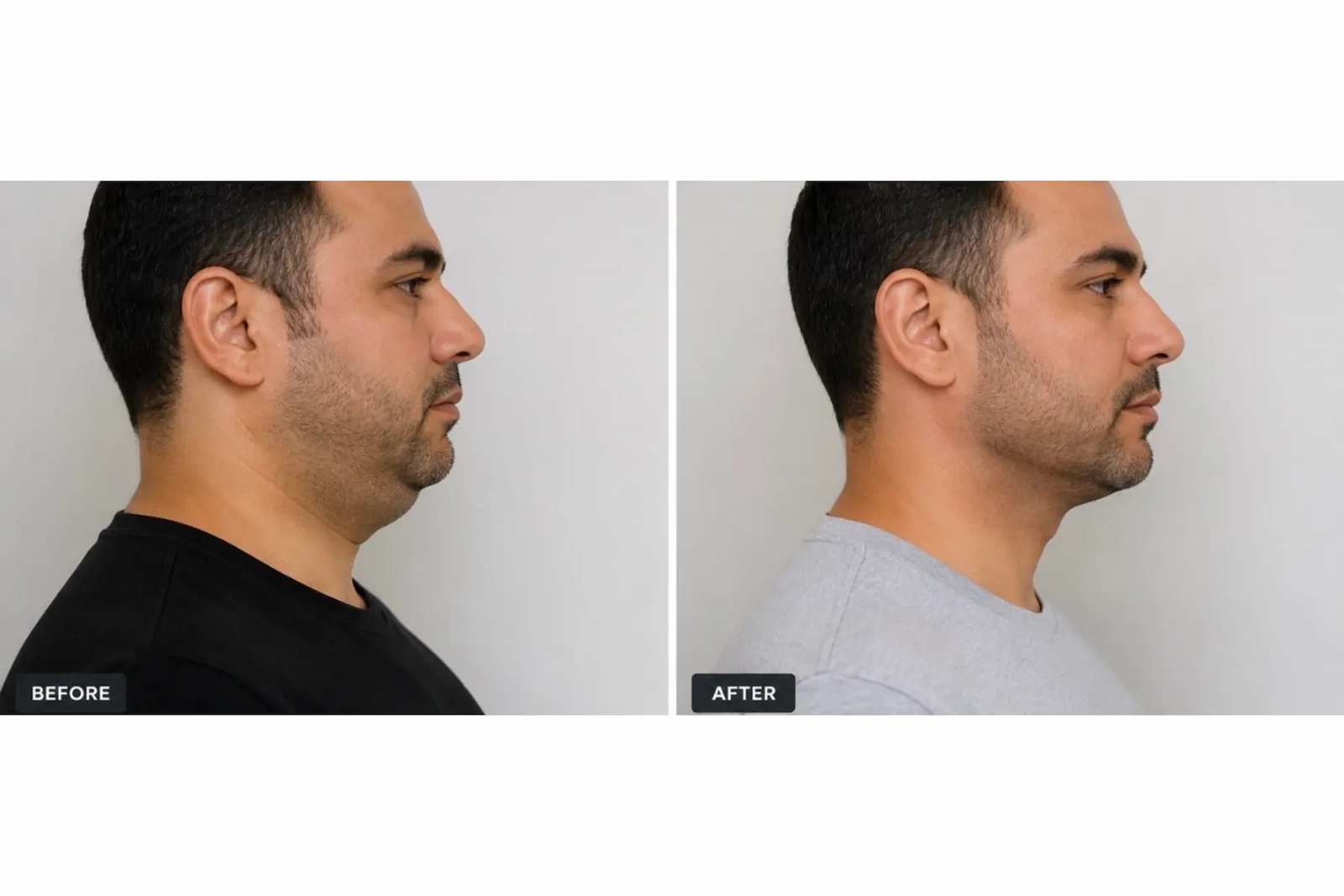 Before and after male jawline contouring and submental definition